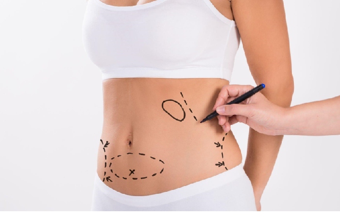 Ten Aesthetic Surgeries - Liposuction