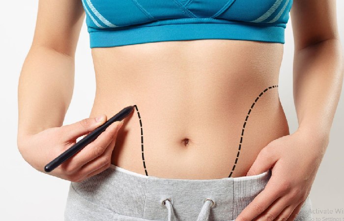 Tummy tuck (abdominoplasty)