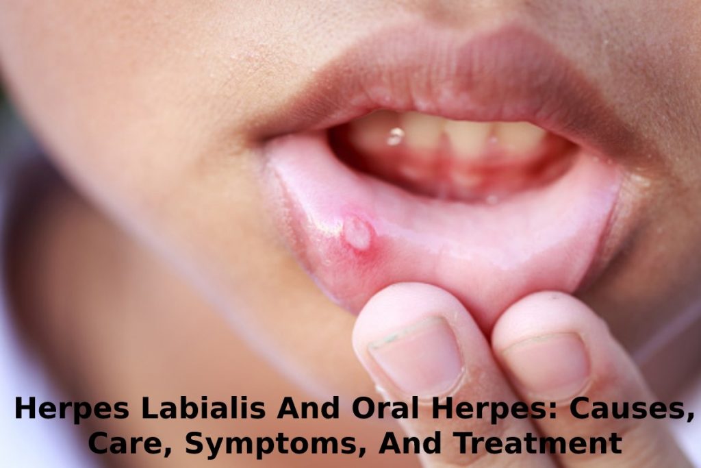 Herpes Labialis And Oral Herpes: Causes, Care, Symptoms, And Treatment