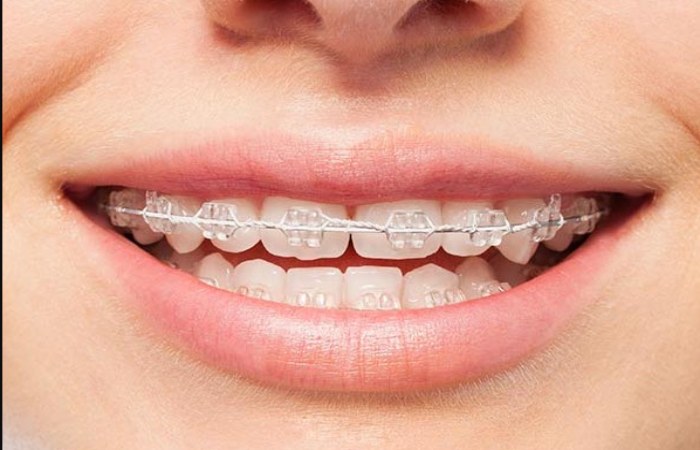 Ceramic Braces