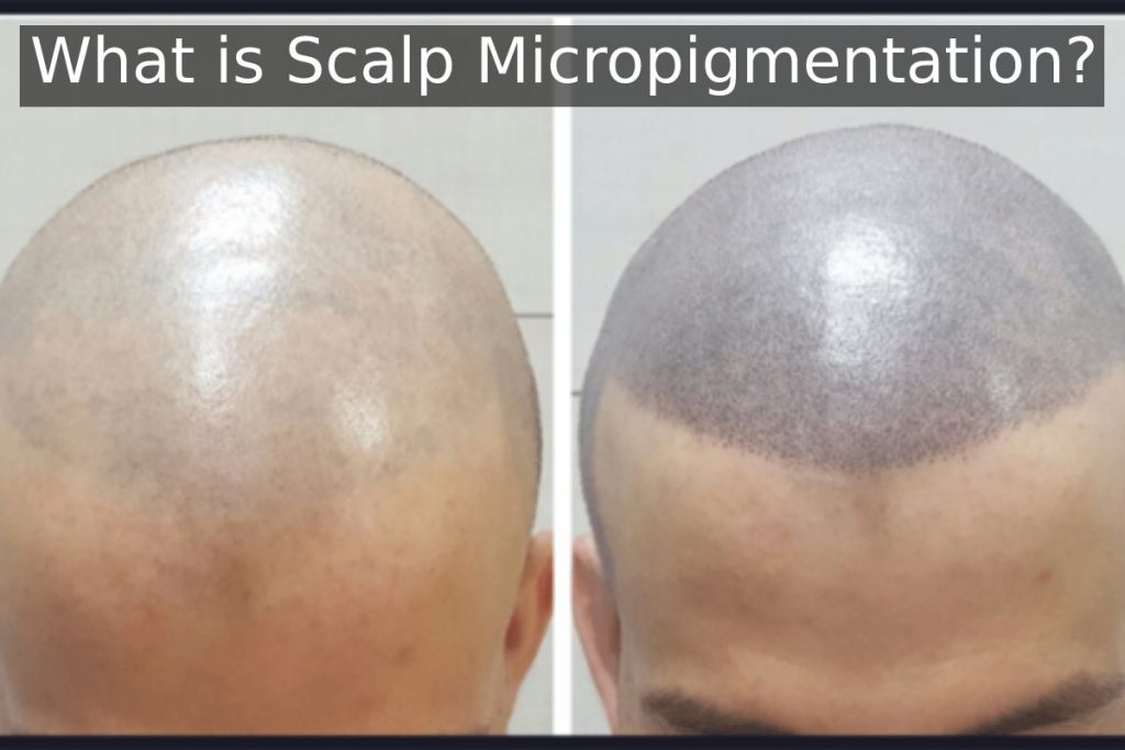 What is Scalp Micropigmentation?