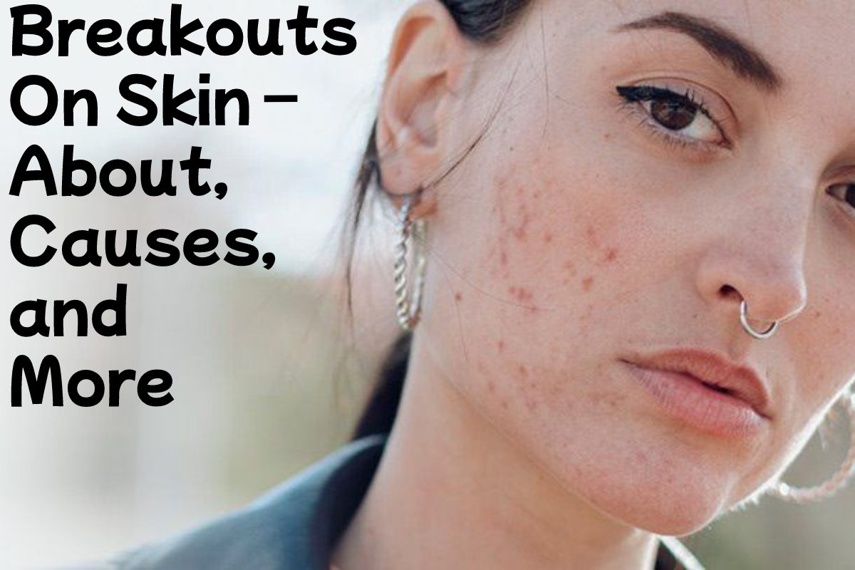 Breakouts On Skin About, Causes, and More