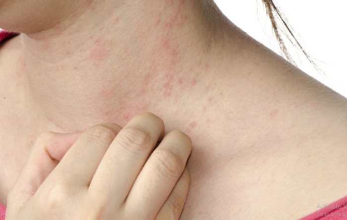 What Is Dermatitis